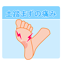 土踏まずの痛み画像
